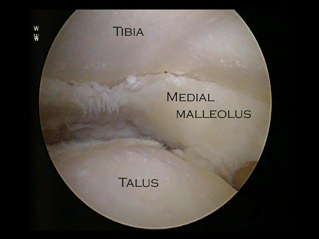 Arthroscopic Ankle Fusion The Foot And Ankle Clinic