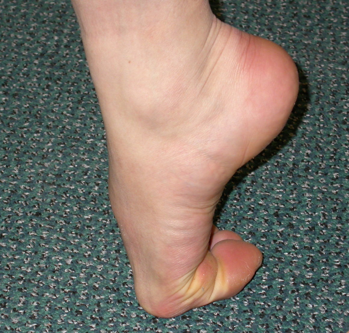 Pain Bottom Of Foot Big Toe Joint At Maryann Guzman Blog