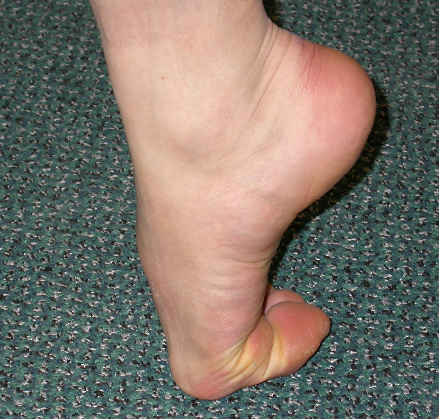 Hallux Rigidus (Big Toe Arthritis 