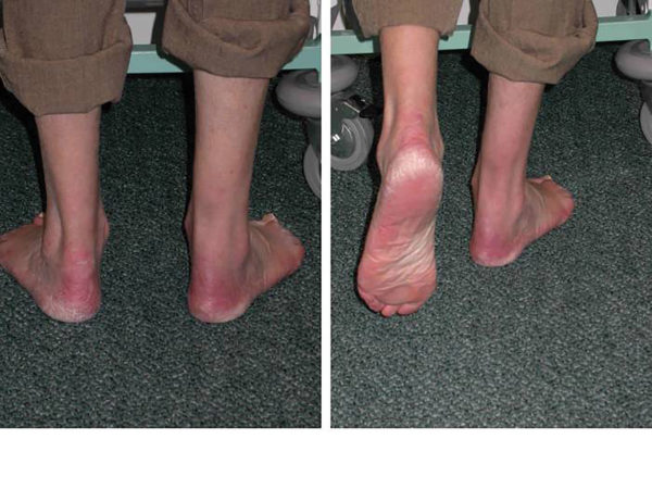 Ruptured Achilles Tendon - The Foot and Ankle Clinic