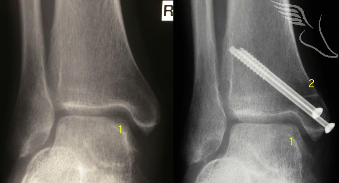 Osteochondral Defect The Foot and Ankle Clinic