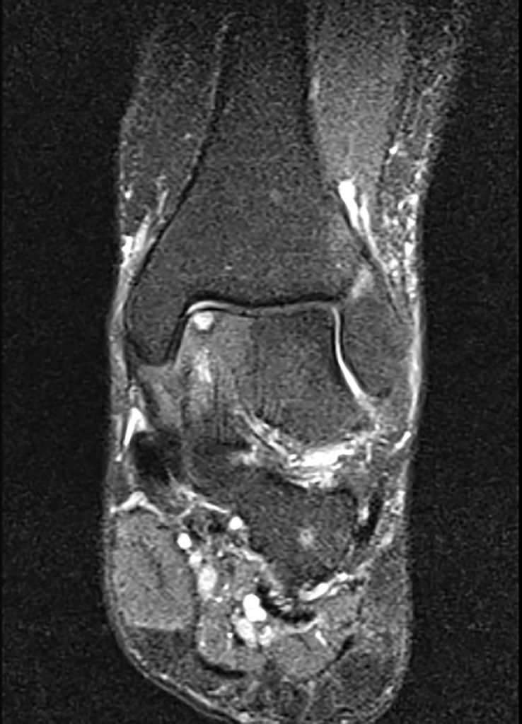 Osteochondral Defect - The Foot and Ankle Clinic